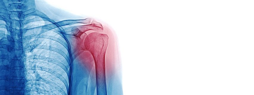 Shoulder Labrum Tears