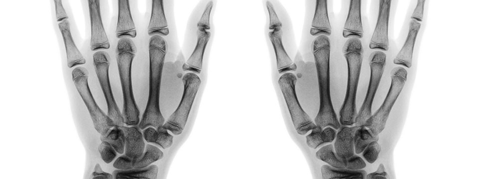 Carpal Tunnel