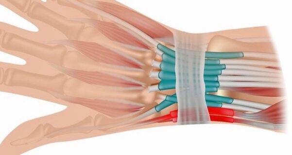 Get Rid of Tendonitis in the Wrist