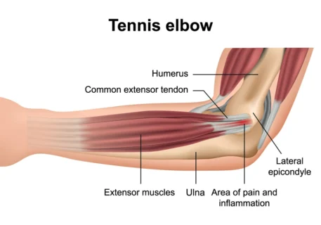 tennis elbow treatment in brookhaven